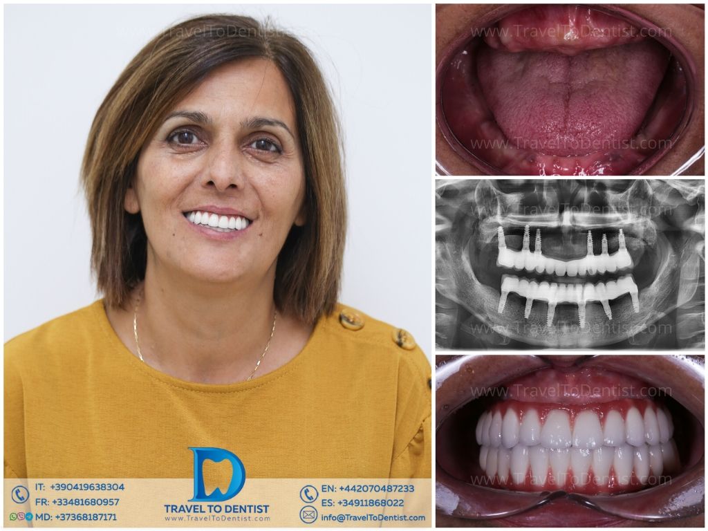 Caso de tratamiento dental 5