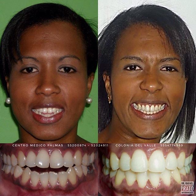 Caso de tratamiento dental 6